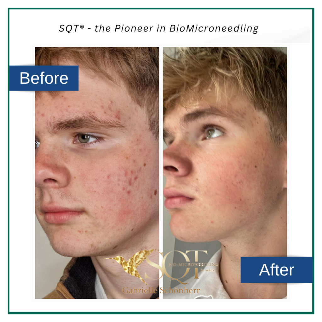 BioMicroneedling