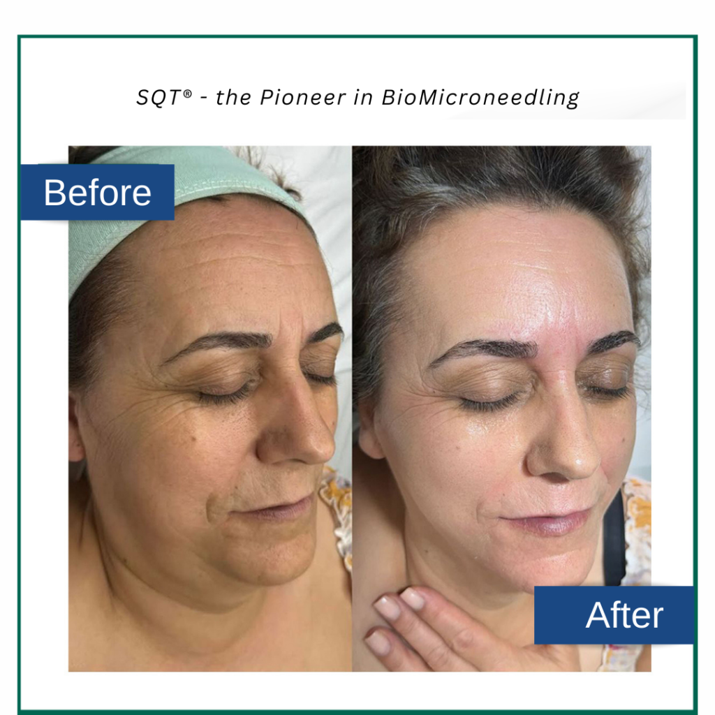 BioMicroneedling