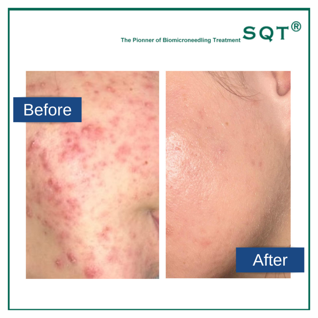 SQT before and after acne