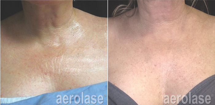 NeoSkin laser for skin tightening & rejuvenation on the chest area at Spa La La in Austin before and after photos
