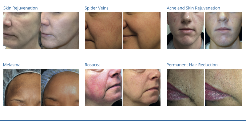 Before and after results of NeoSkin laser treatments showing improvements for skin rejuvenation, spider veins, acne, melasma, rosacea, and hair reduction at Spa La La in Austin